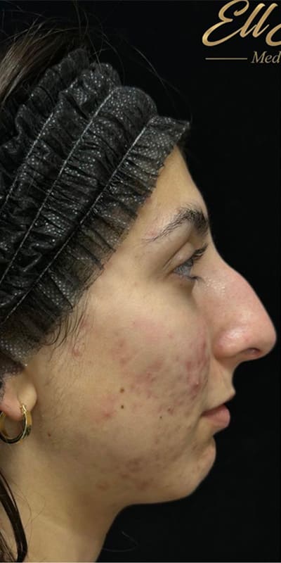 Vi Peel Before & After Image