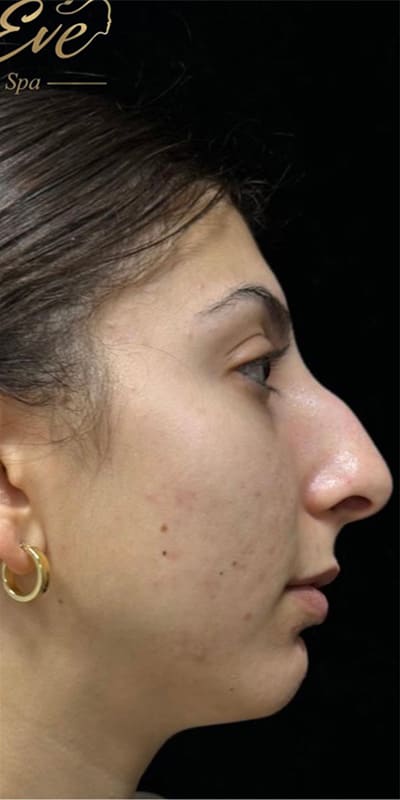 Vi Peel Before & After Image