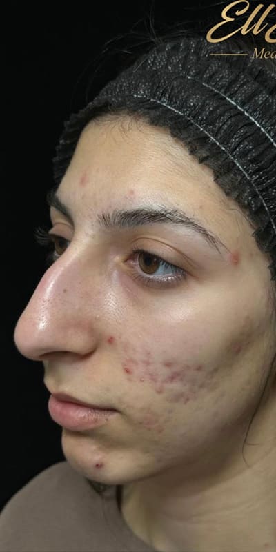 Vi Peel Before & After Image