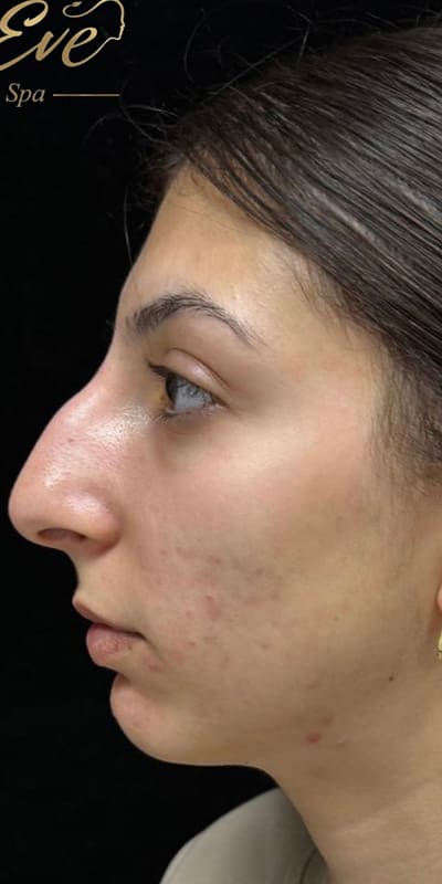 Vi Peel Before & After Image